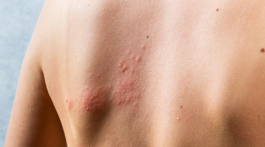Image of a skin reaction on the back.
